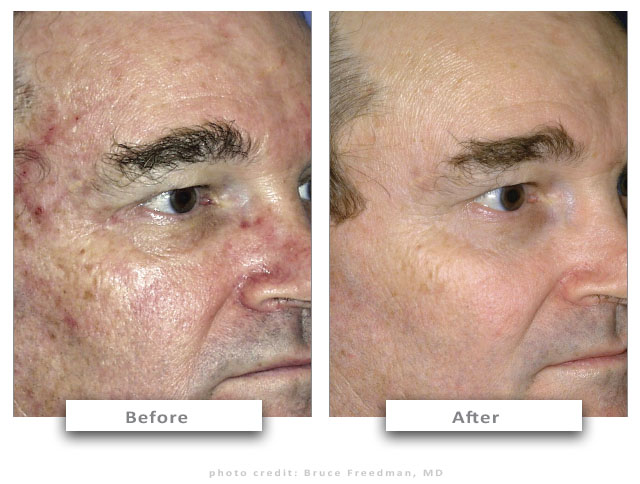 aser Hair Removal & Skin Treatments