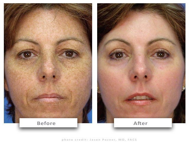 2-before-after-micropeel-cc