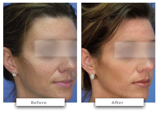 5 - before-after-micropeel-cc