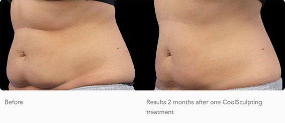 CoolSculpting