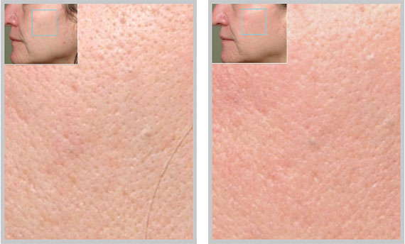 Fractional Resurfacing - ProFactional Therapy