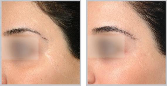 Fractional Resurfacing - ProFactional Therapy