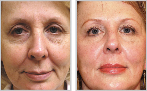 Fractional Resurfacing - ProFactional Therapy