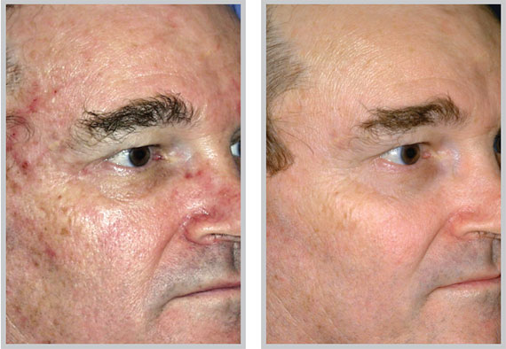 Superficial Skin Resurfacing - MicroLaserPeel