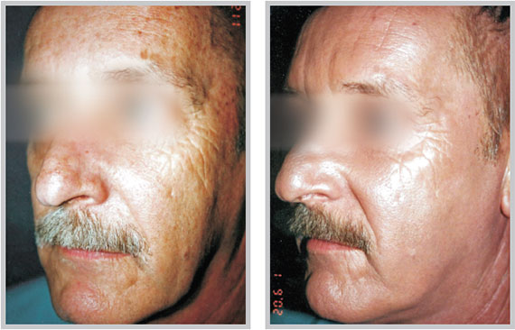 Superficial Skin Resurfacing - MicroLaserPeel