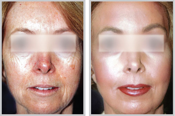 Laser Peel – Countour TRL Skin Resurfacing