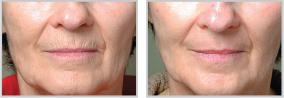 Laser Peel – Countour TRL Skin Resurfacing