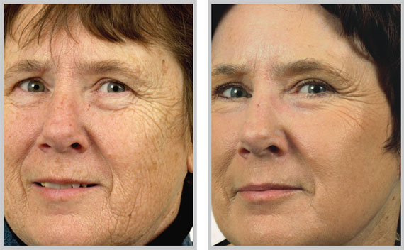 Laser Peel – Countour TRL Skin Resurfacing
