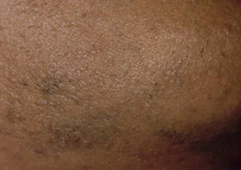 Laser Hair removal reduction woman chin before treatment at Christina Clinic
