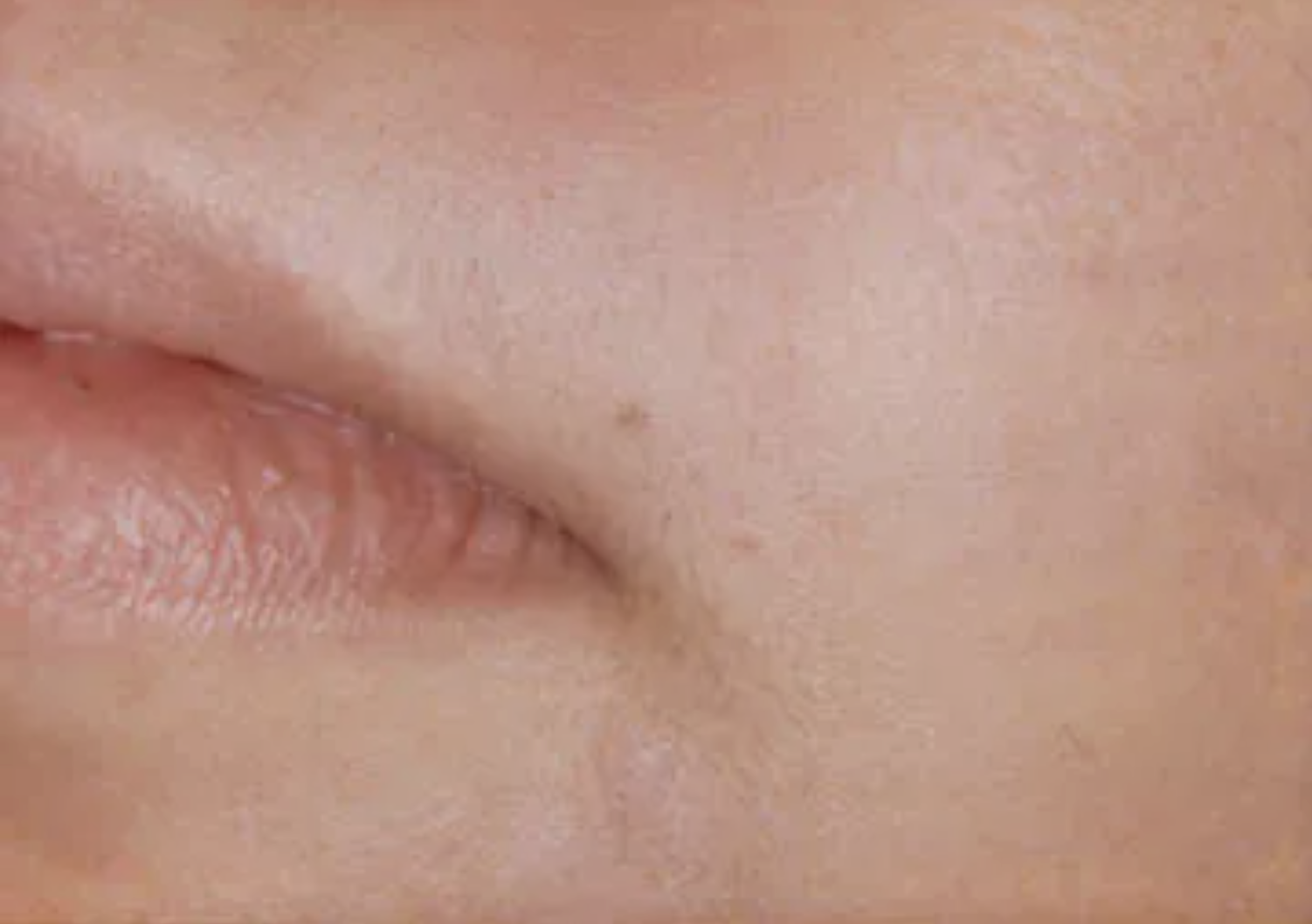 Christina Clinic Laser Hair Removal After Lip