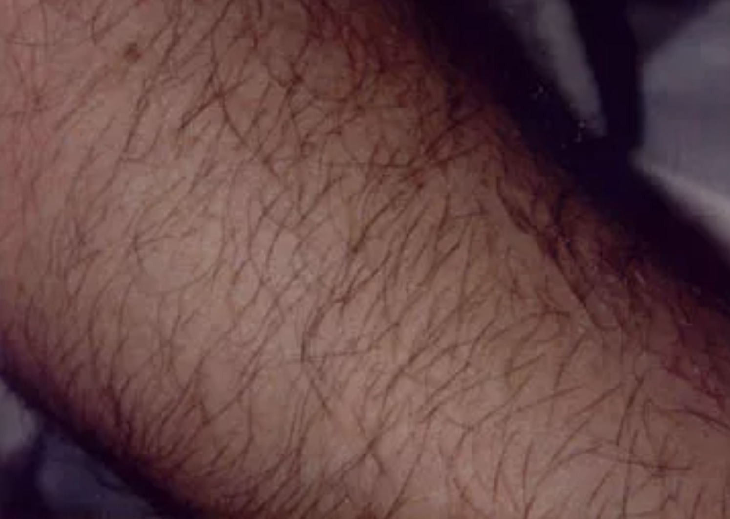 Christina Clinica Laser Hair Removal Female Arm – Before and 5 months after 1st treatment