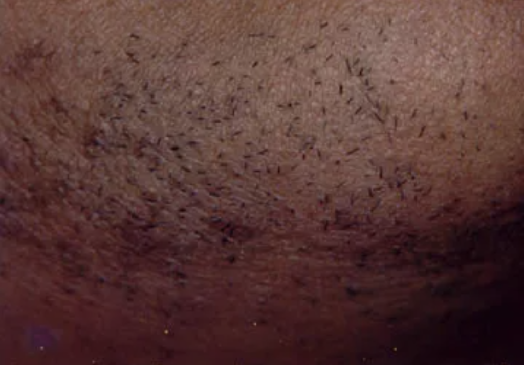 Laser Hair removal reduction woman chin before treatment at Christina Clinic