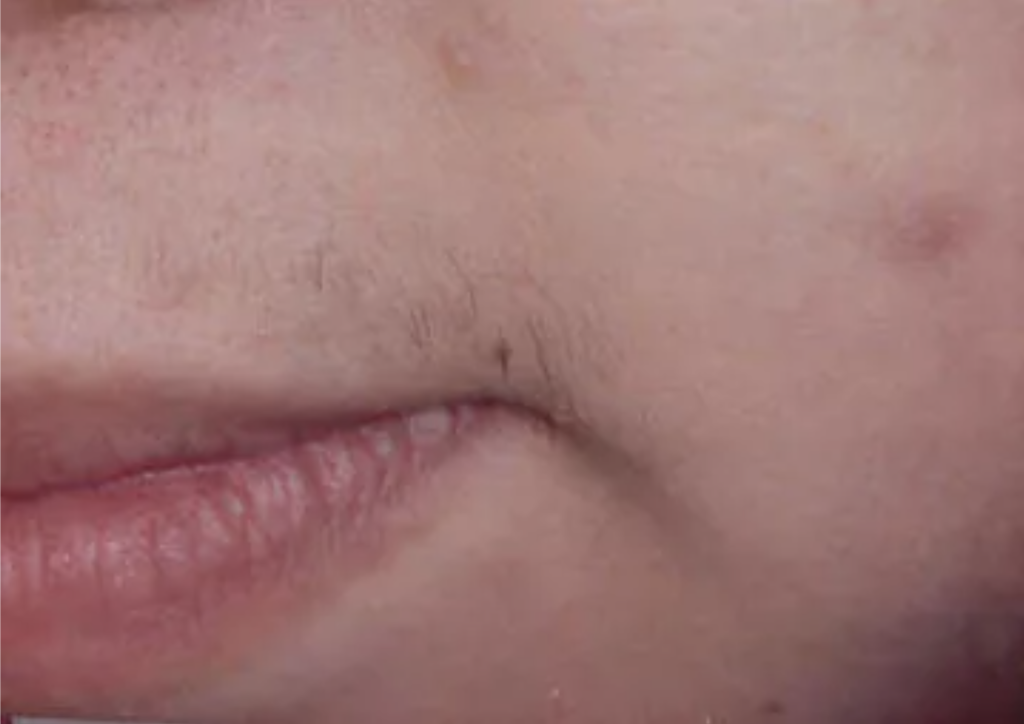 Christina Clinic Laser Hair Removal Before Lip