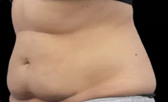 CoolSculpting Experts at Christina Clinic - before stomach