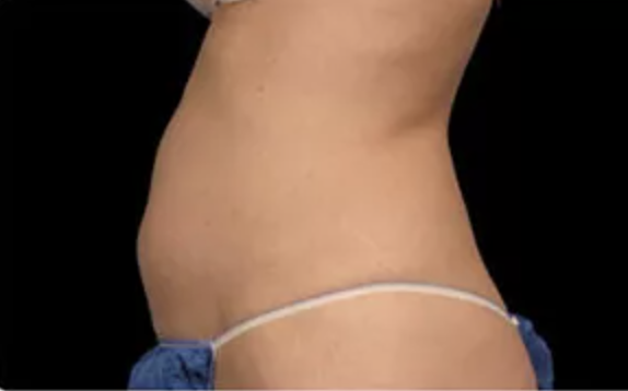 CoolSculpting Experts at Christina Clinic - Before treatment