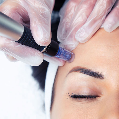 Rejuvenated Skin w/ Microneedling