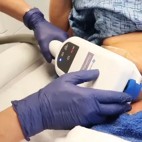 Coolsculpting