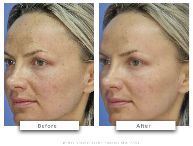3-before-after-micropeel-cc