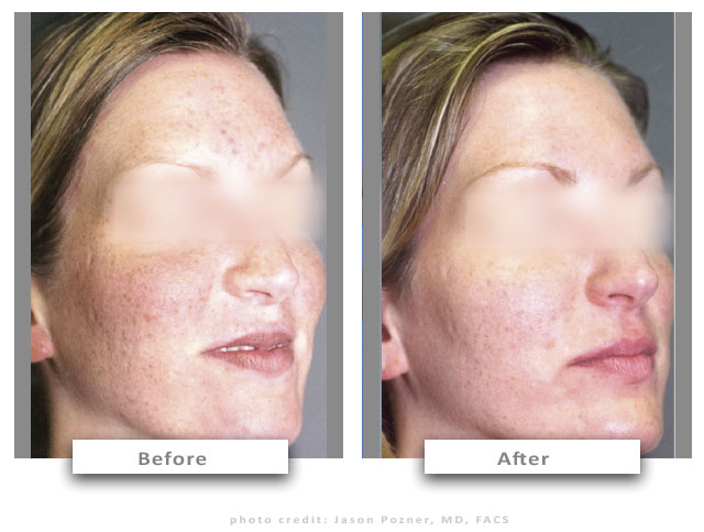 4-before-after-micropeel-cc