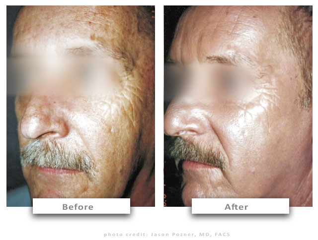 7-before-after-micropeel-cc