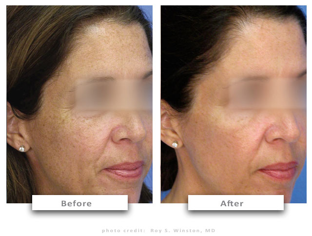 8-before-after-micropeel-cc